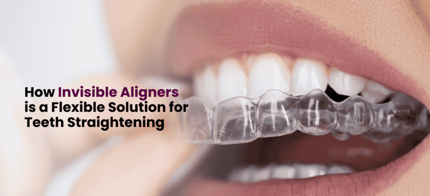 How Invisible Aligners is a Flexible Solution for Teeth Straightening