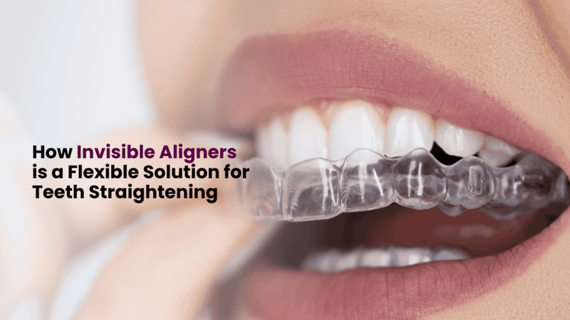 How Invisible Aligners is a Flexible Solution for Teeth Straightening