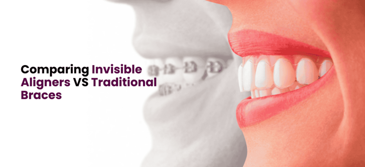 Comparing Invisible Aligners VS Traditional Braces