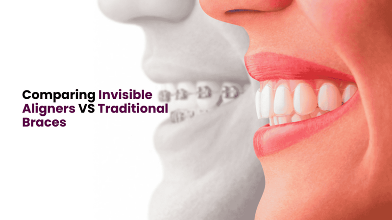 Comparing Invisible Aligners VS Traditional Braces