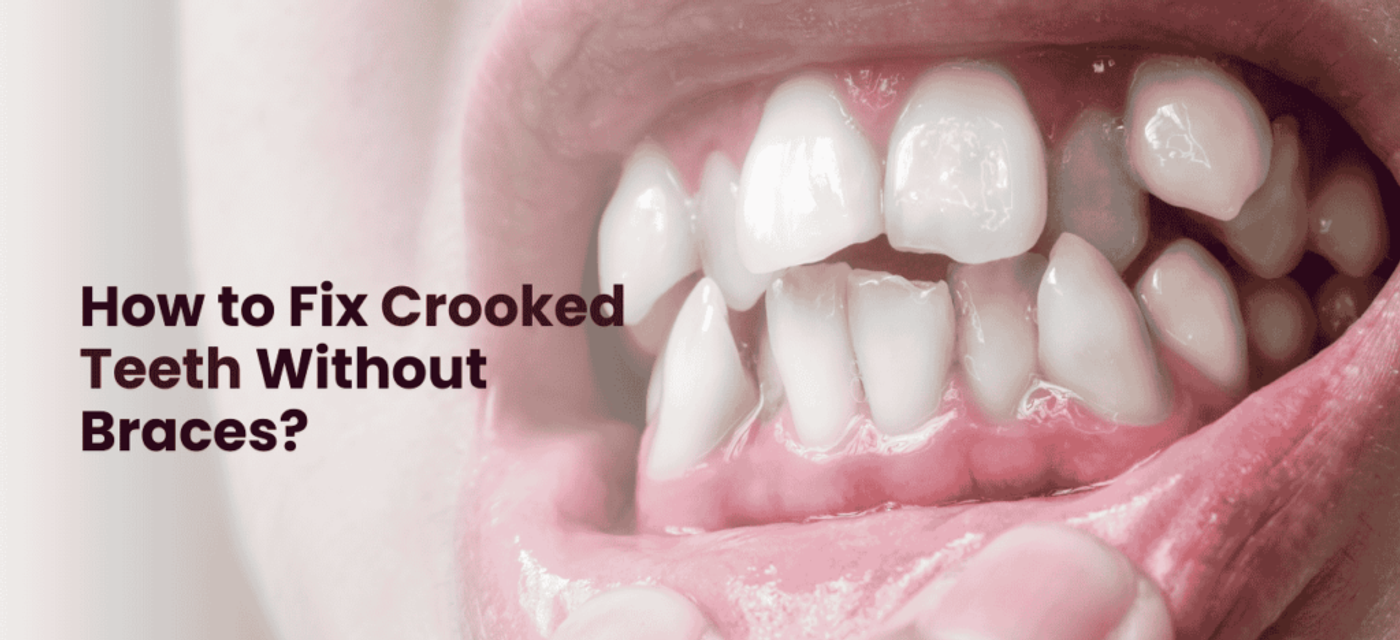 How to Fix Crooked Teeth Without Braces?
