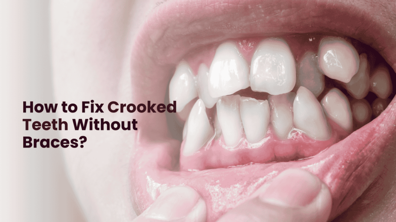 How to Fix Crooked Teeth Without Braces?