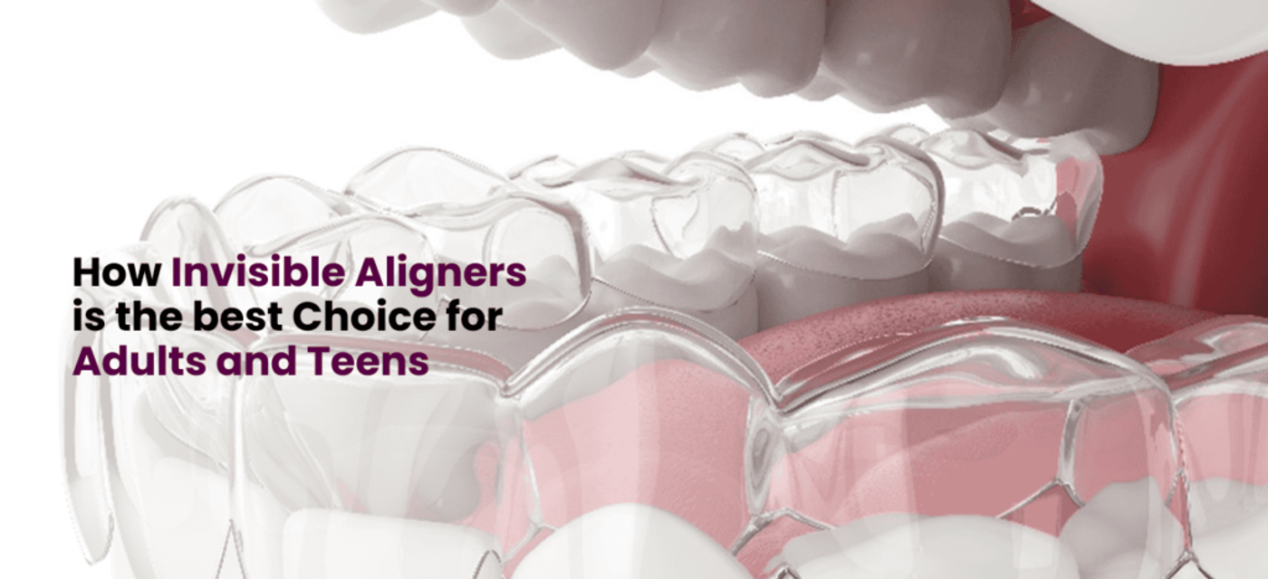 How Invisible Aligners is the best Choice for Adults and Teens