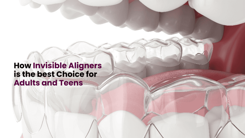 How Invisible Aligners is the best Choice for Adults and Teens