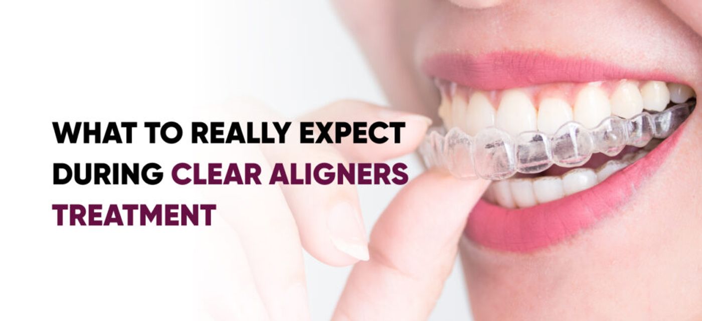What to Really Expect During Clear Aligners Treatment