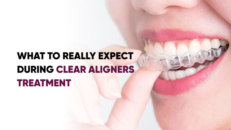 What to Really Expect During Clear Aligners Treatment