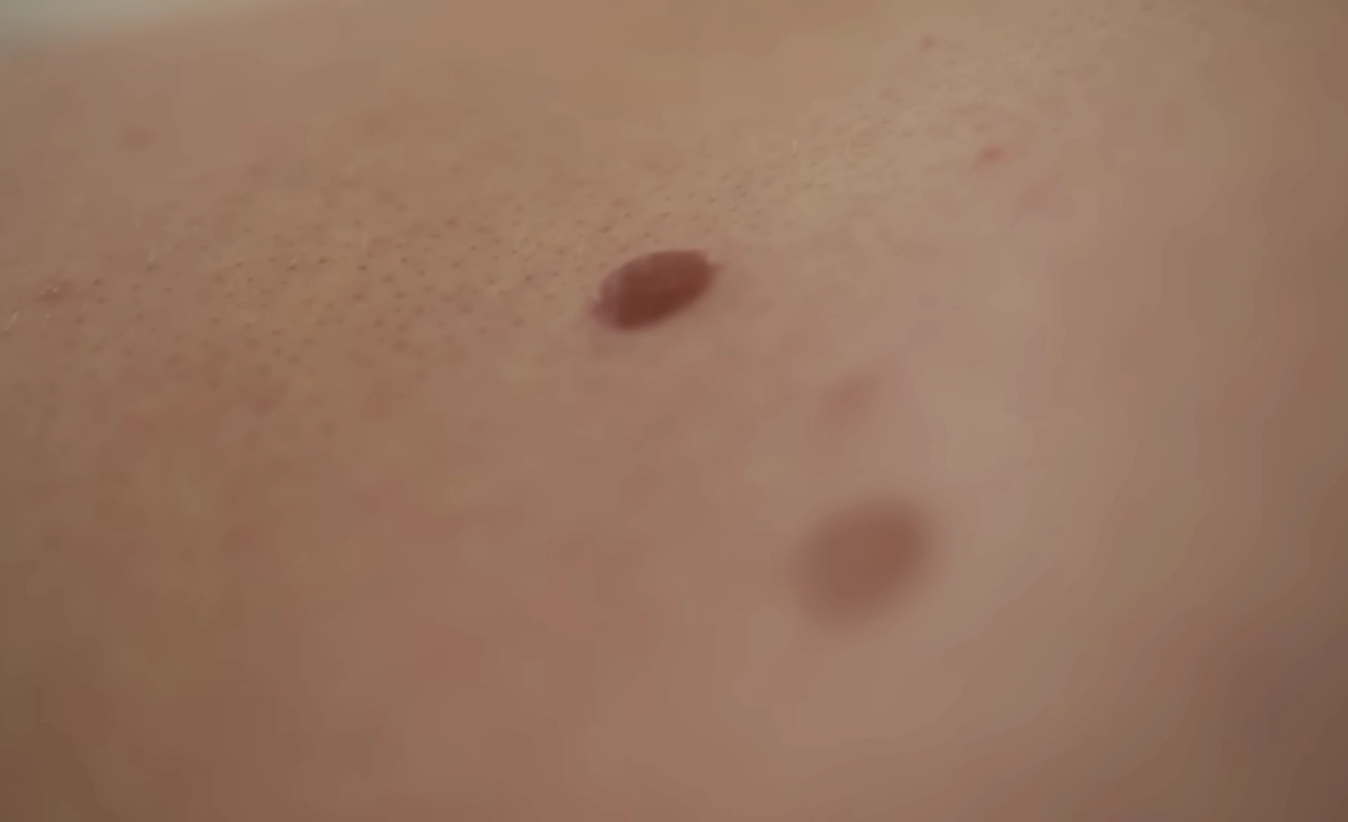 Photograph and monitor moles so you can spot changes or developments