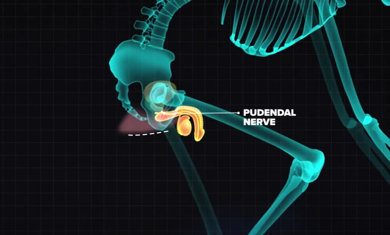 Numbness occurs when there is pressure on the pudendal nerve