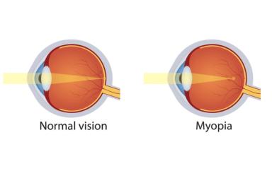 
A normál látás és a rövidlátás azaz myopia különbsége grafikai ábrával


