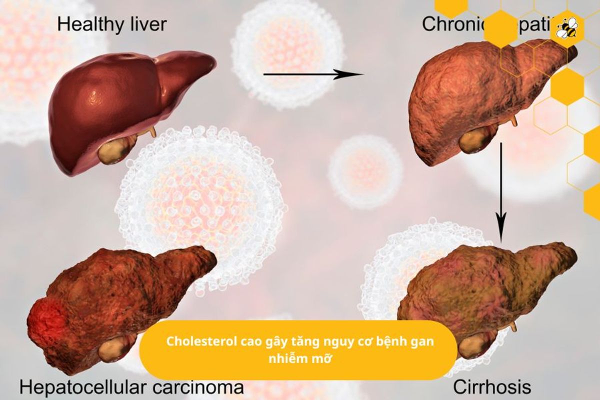 Cholesterol cao gây tăng nguy cơ bệnh gan nhiễm mỡ