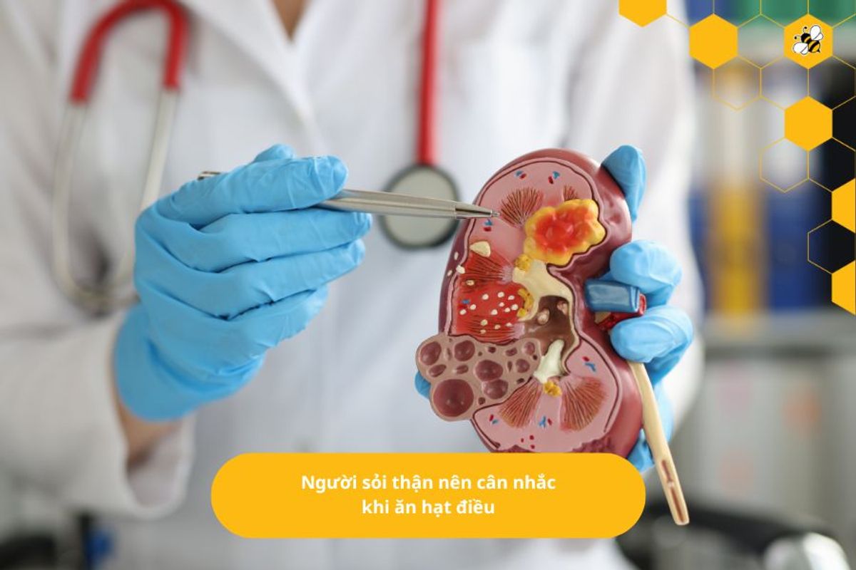 Người sỏi thận nên cân nhắc khi ăn hạt điều