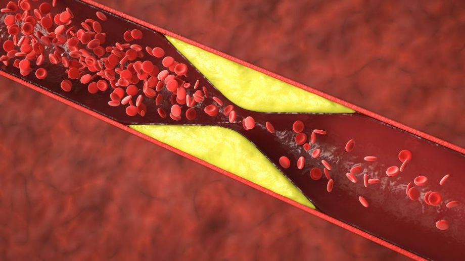 Hạt điều có chứa cholesterol không