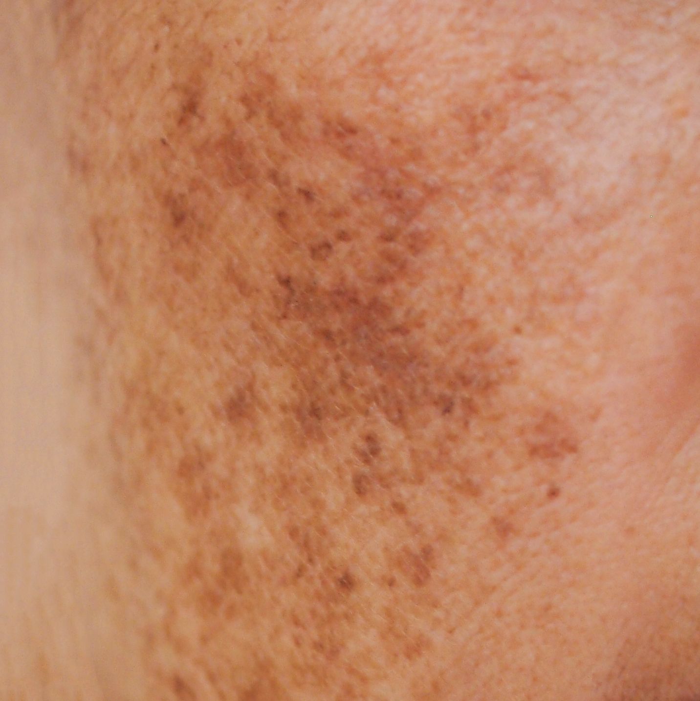 Hyperpigmentation