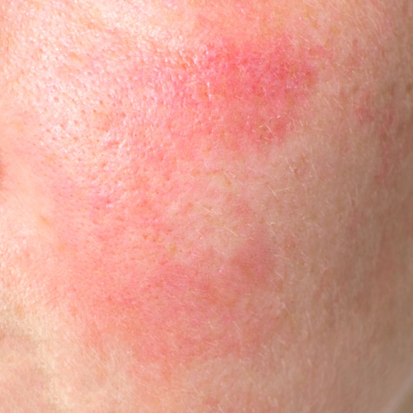 Redness or Rosacea