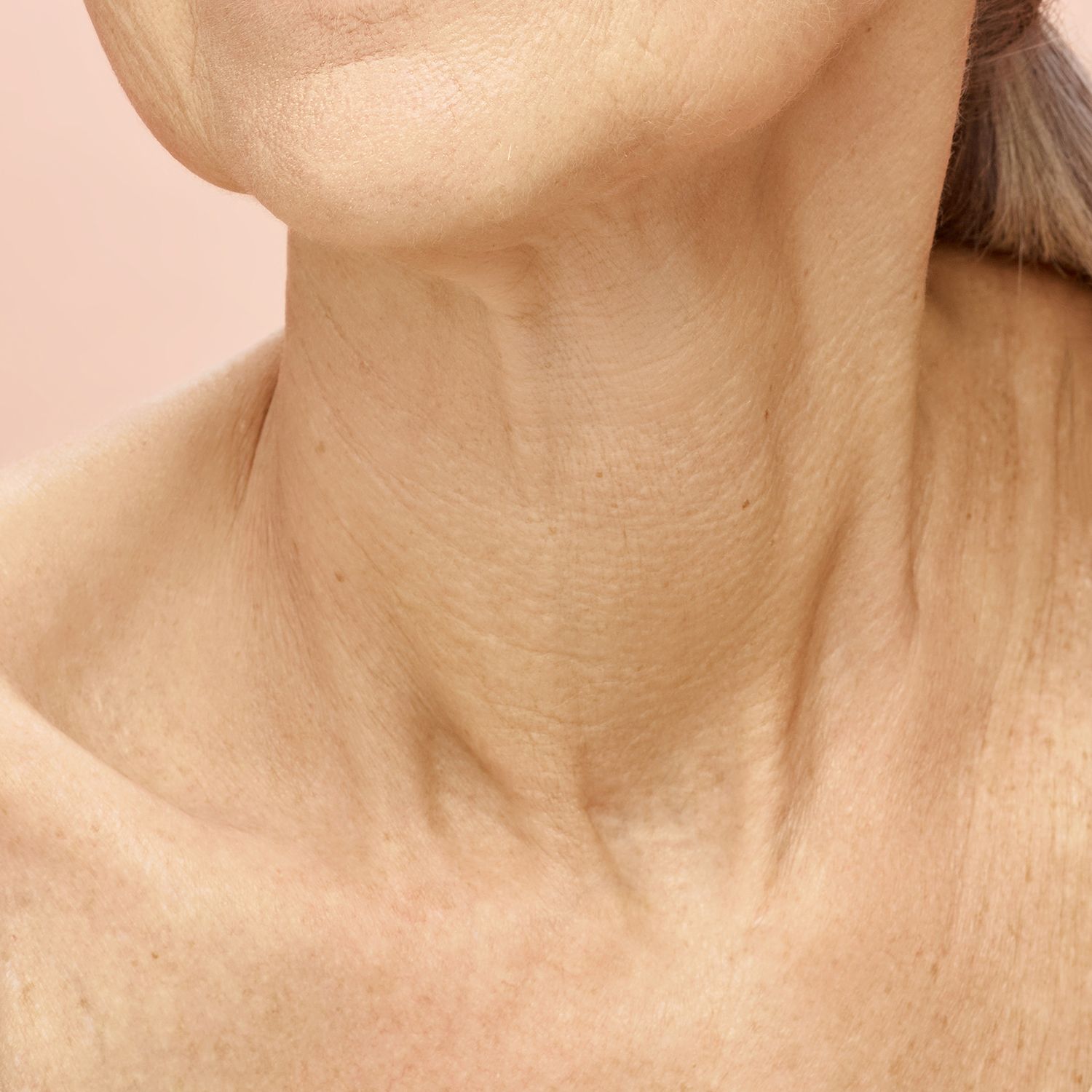 Neck and Chest Rejuvenation