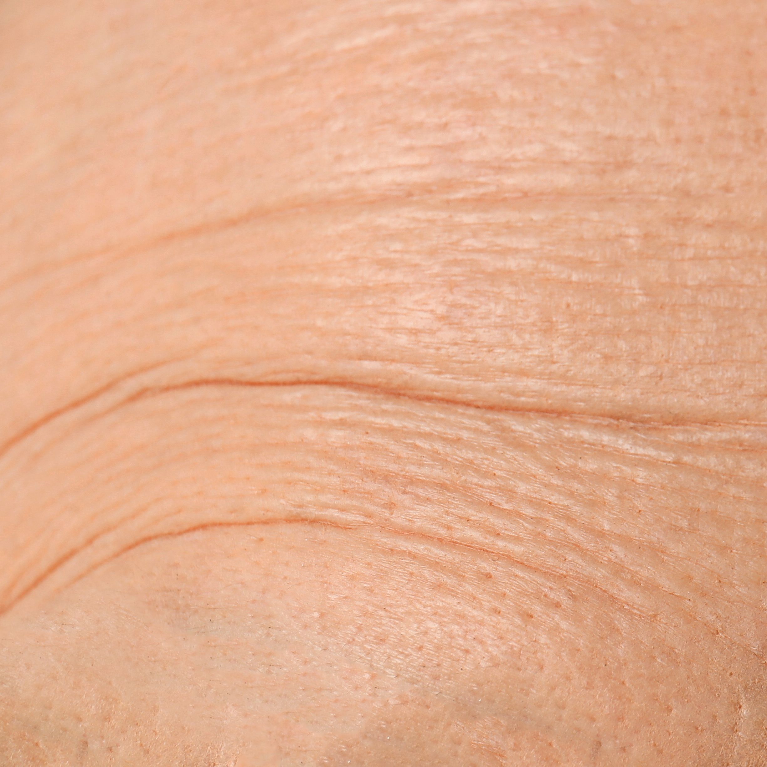 Skin aging and wrinkles