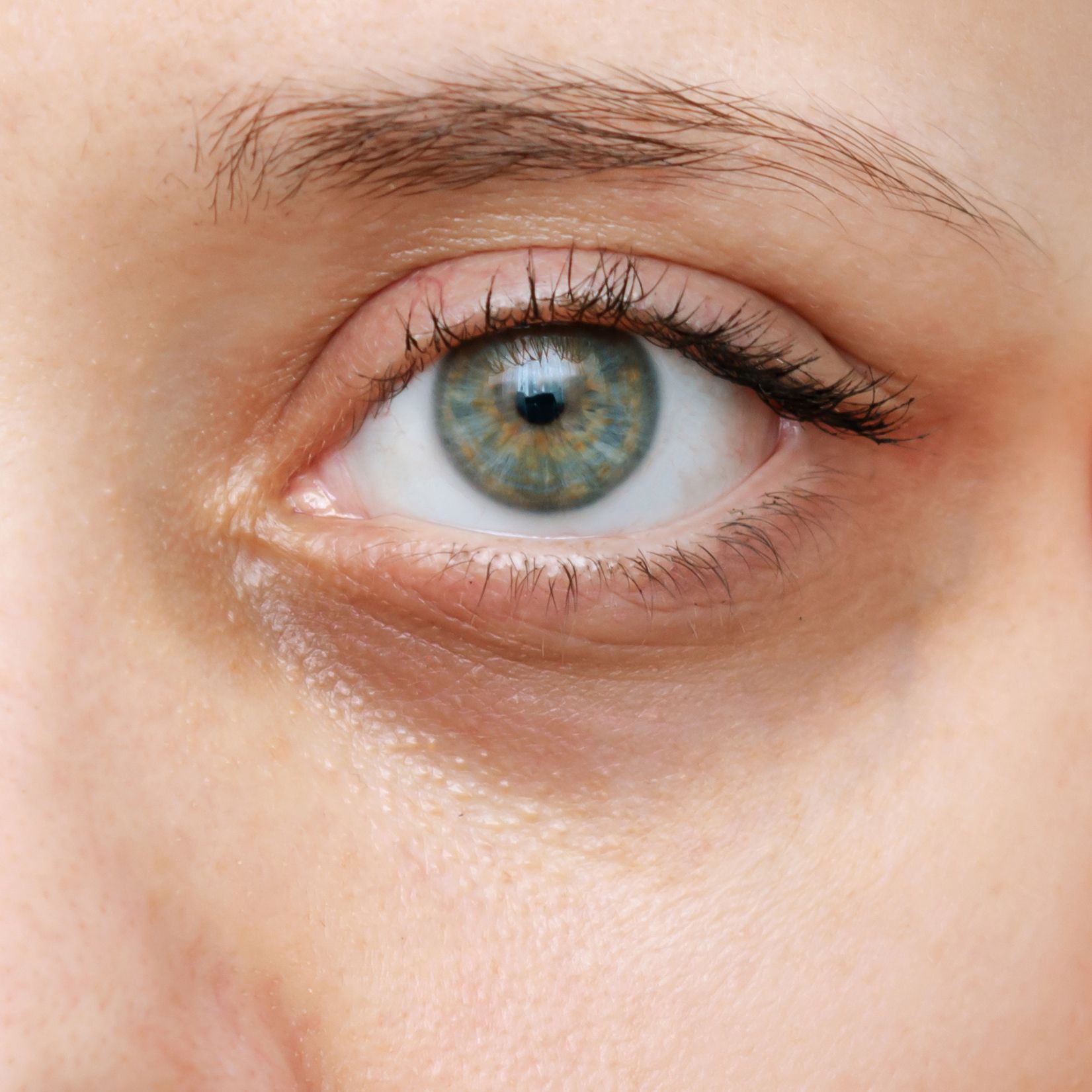 Under-eye hollows and dark circles