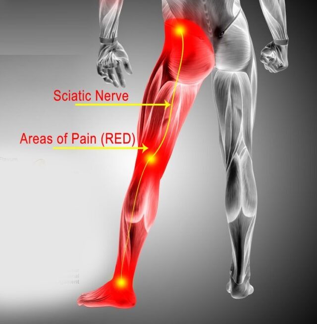 Sciatica area of pain 