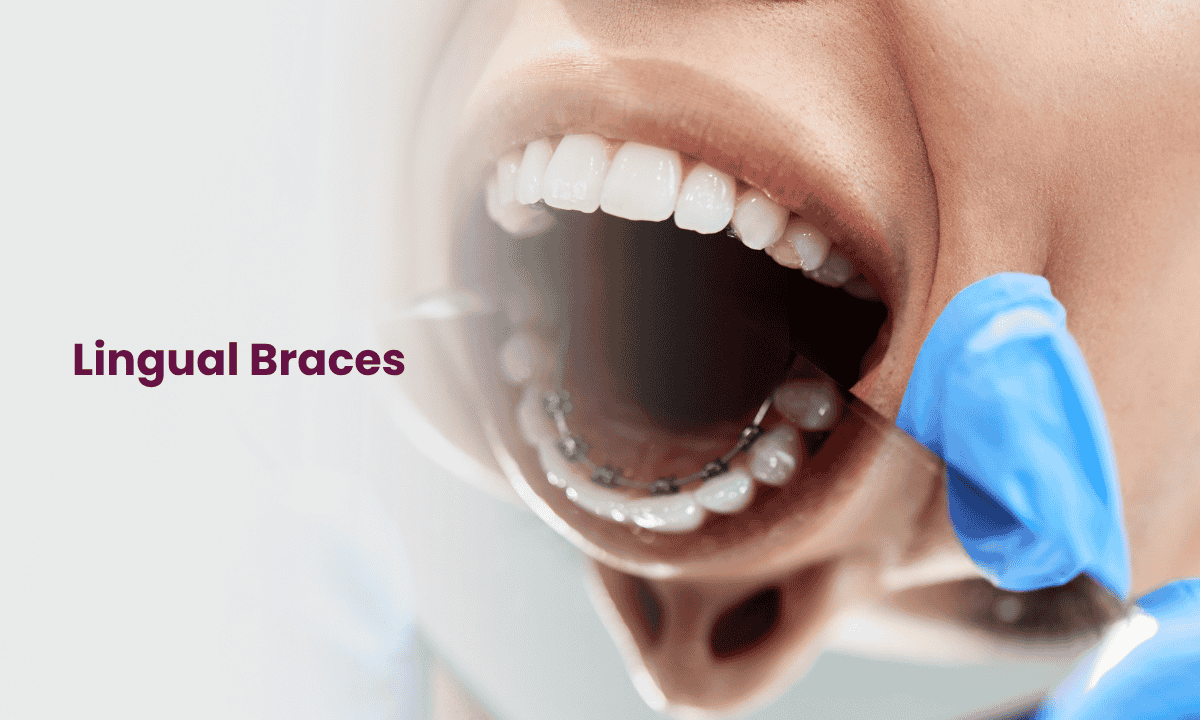 Lingual Braces