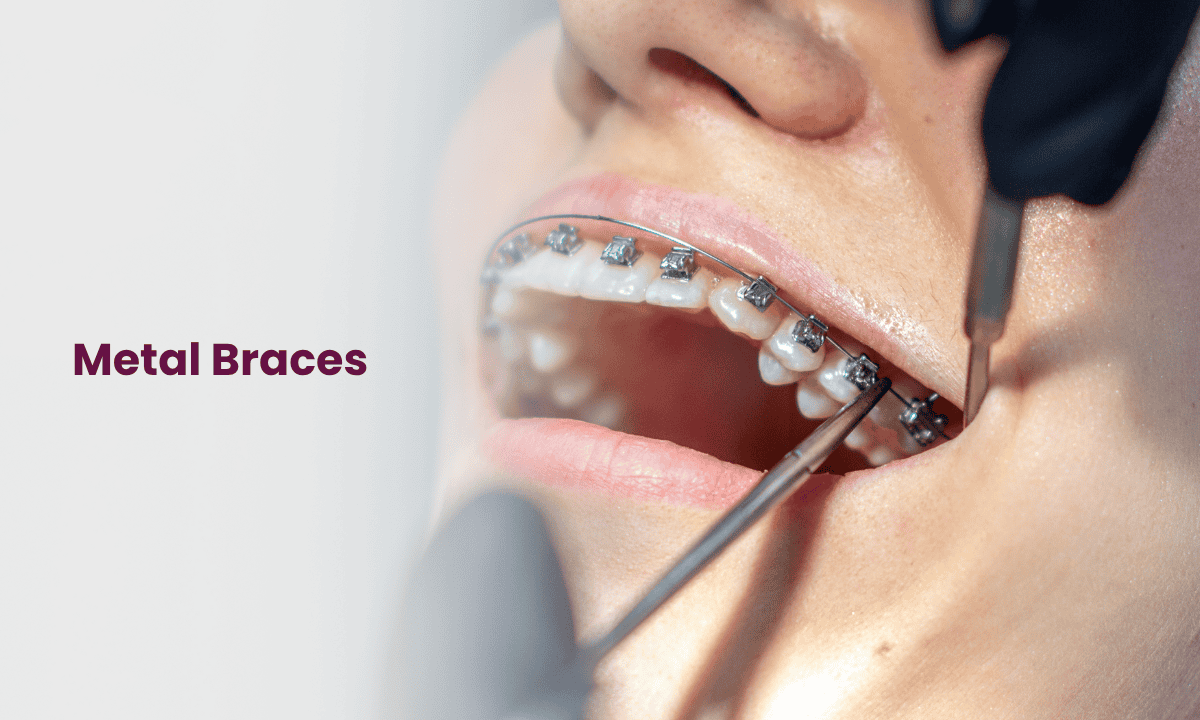 Dental Braces