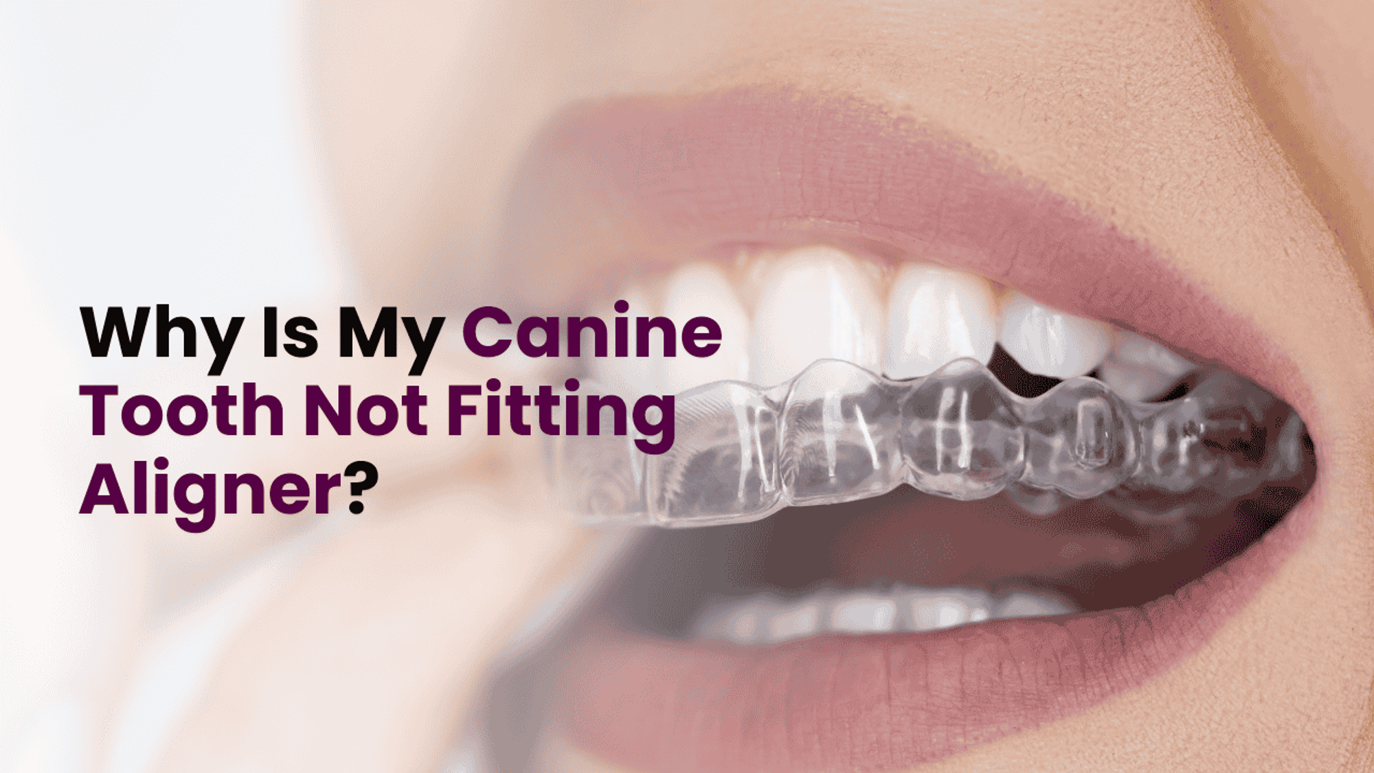 Why Is My Canine Tooth Not Fitting Aligner? Causes and Solutions