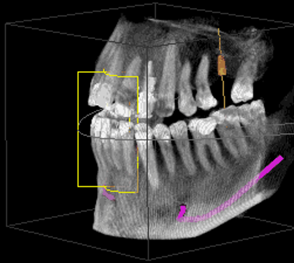 Dental Impressions