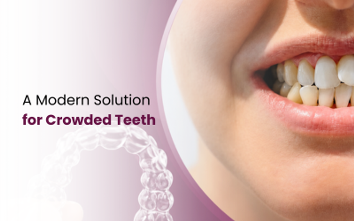 Dental Crowding Teeth