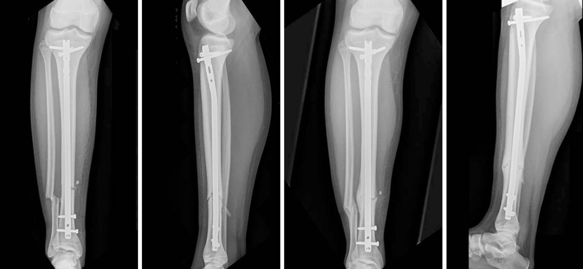 Spontaneous Posterior Migration of an Antegrade, Reamed Intramedullary Tibial  Nail Following Locking Bolt Removal, a Delayed Presentation