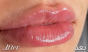 Lip Filler after