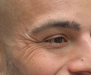 Under Eye Botox before