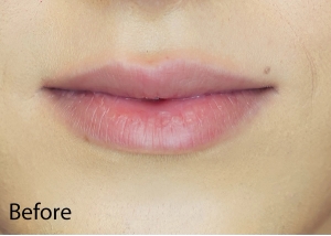 Lip Filler before