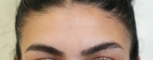 Forehead Botox after