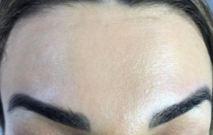 Forehead Botox after