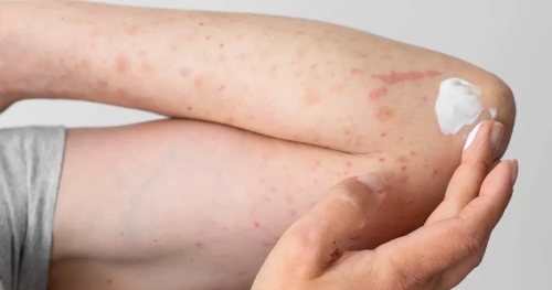 Keratosis Pilaris Treatment