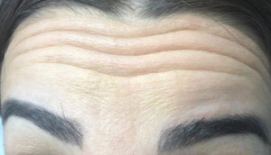 Forehead Botox before