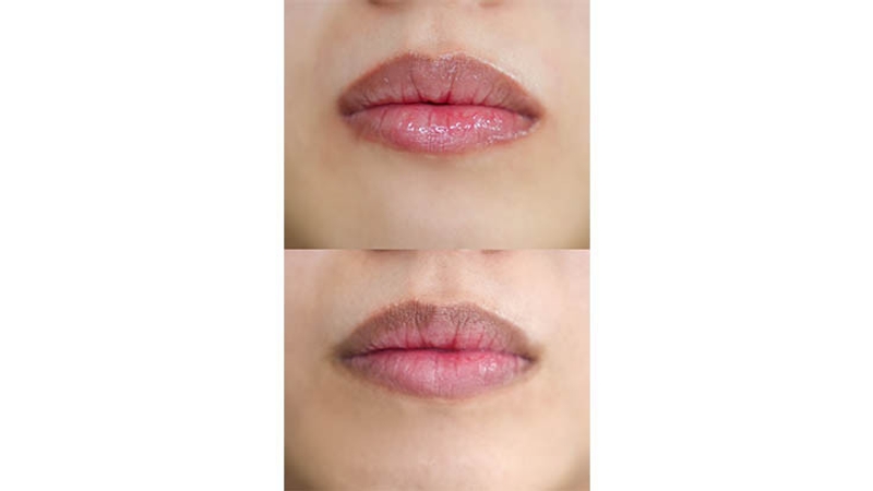 Before and after laser hair removal at Storax Clinic, Dubai