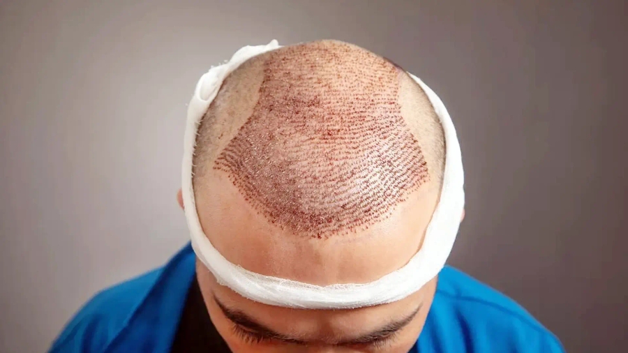 Hair Transplant Cost in the UAE