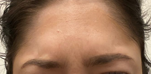 Forehead Botox after