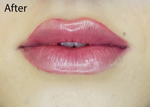 Lip Filler after