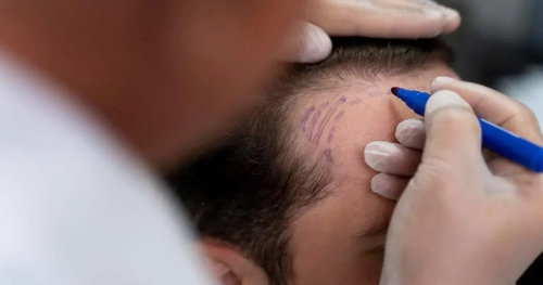 Scalp Micropigmentation (SMP) Dubai