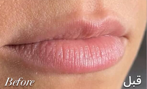 Lip Filler before