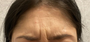 Forehead Botox before