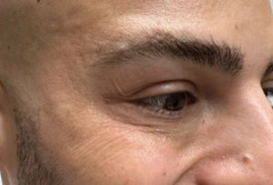 Under Eye Botox after