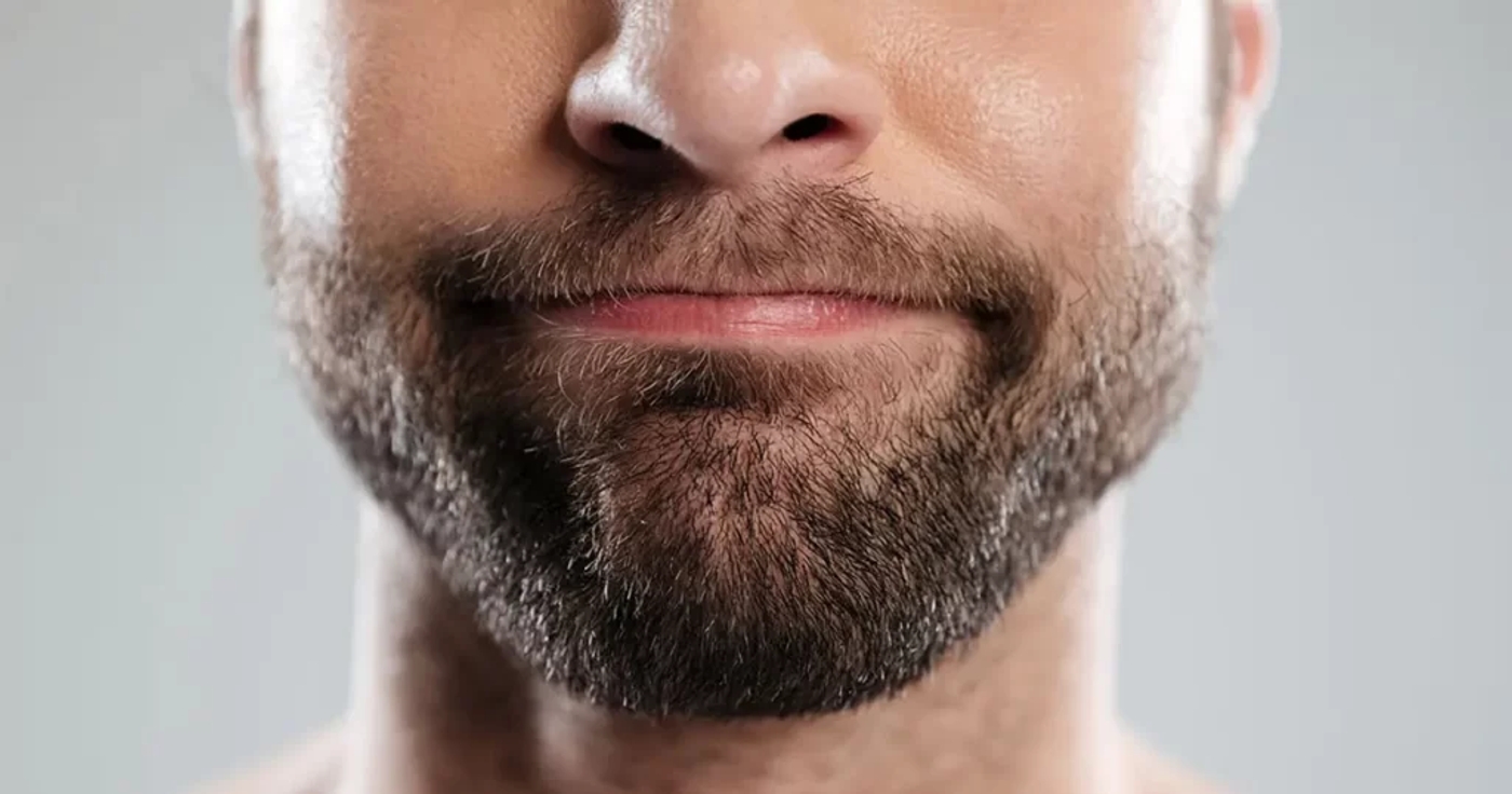 Beard Transplant