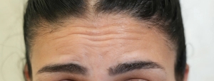 Forehead Botox before