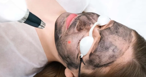 Carbon Laser Face Rejuvenation