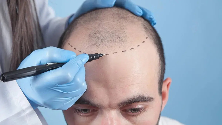 FUE Hair Transplant