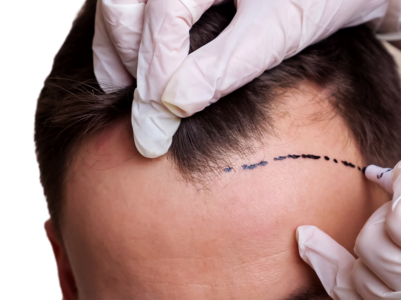 Scalp Micropigmentation (SMP) Dubai