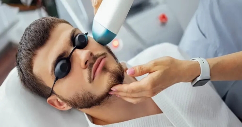 Beard Laser Hair Removal