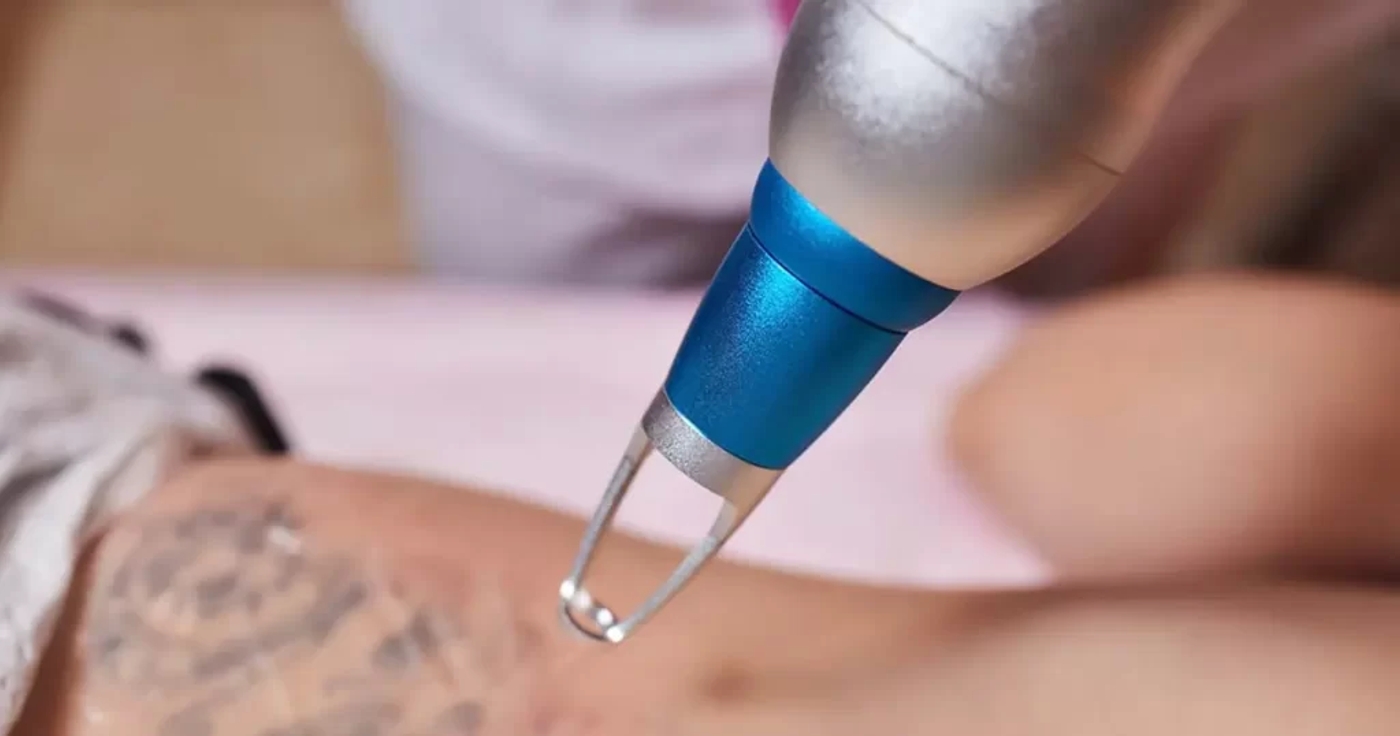 Laser Tattoo Removal